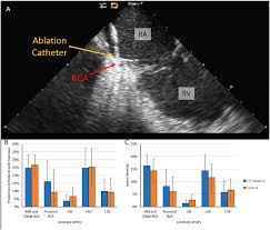 Poster PO-484266: Poster Session III - Ablation PO-03-103 PO-03-104