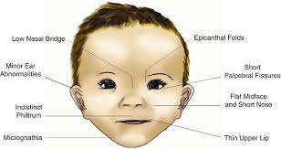 An epicanthal fold is also common in children with down syndrome. Fetal Alcohol Syndrome Springerlink