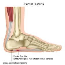 The mean visual analogue pain score dropped from 8.5 of 10 preoperatively to 2.5 of 10 postoperatively. Plantar Fasciitis Surgery Injury Causes Symptoms And Treatments