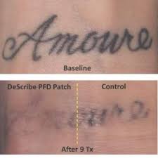 See reviews, photos, directions, phone numbers and more for free gang tattoo removal clinic locations in chicago, il. Gel Patch Speeds Laser Tattoo Removal Mdedge Dermatology