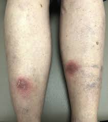 Image result for erythema nodosum