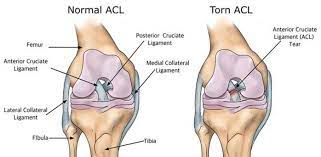 We did not find results for: Why Do I Have To Wait So Long After My Acl Reconstruction Back In Action