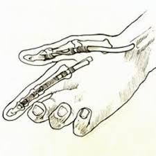 It serves as the upper attachment point for the superficial muscles of the front of the forearm Flexor Tendon Injury The British Society For Surgery Of The Hand