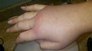 Swollen Hands Exercise Other Causes And Treatment