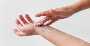 Image result for Eczema nummulare