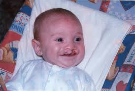 Cleft Lip & Palate Association