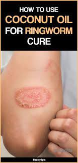How To Use Coconut Oil For Ringworm Cure Ringworm Cure Home Remedies For Ringworm The Cure