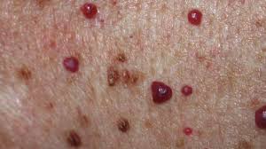 Though, a cherry angioma on scalp is rare and often asymptomatic 1, they can lead to massive bleeding if injured. What Is A Cherry Angioma Causes Treatment And Removal