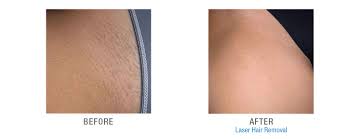 This might be on account of the fact of lower penetration depth of laser in laser hair removal process. Laser Hair Removal Pregnancy Regrowth Pregnancywalls