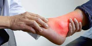 Sering kali ketika terasa sakit pada pergelangan kaki, orang langsung mengira dirinya terkena asam urat. 8 Ciri Ciri Asam Urat Di Kaki Dan Penyebabnya Yang Wajib Diketahui Merdeka Com