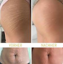 4.2 menschen, die schnell eine größere menge gewicht zunehmen. Schwangerschaftsstreifen Sandra S Gesundheits Und Beautyblog