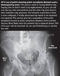 Image result for Hip XRay