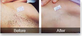 For a package with 5 to 6 sessions, laser hair removal for small area costs $220 to $800. Before After Lumiere Skin And Laser