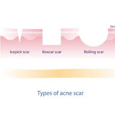 Maybe you would like to learn more about one of these? Types Of Acne Scars And How To Treat Them