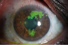 Herpes simplex i of the lips and. The Three Faces Of Herpes Simplex Epithelial Keratitis A Steroid Induced Situation Bmj Case Reports
