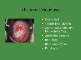 What does bv look like pictures. Pin On Reproductive Health
