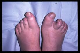 Перевод слова foot, американское и британское произношение, транскрипция, словосочетания, однокоренные слова, примеры использования. Psoriasis And Psoriatic Arthritis On The Feet
