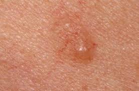 But a biopsy of the pimple in nov. When Cancer Can Mimic An Earlobe Pimple Know The Signs Scary Symptoms