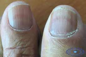 The chronic renal insufficiency cohort (cric) study. Nail Disorders In Patients With Chronic Renal Failure