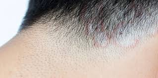 Pityriasis versicolor presents as asymptomatic flaky patches on the trunk, neck, and/or arms, which persist for months or years. Pityriasis Versicolor Treatment Clear Skin Clinic