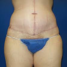 Search for tummy tuck with us. Tummy Tuck Archives Cosmetic Surgery