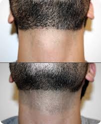 This top hair remover is formulated for black men with regular beards and works in just four minutes. Electrolysis Permanent Body Hair Removal For Men Peach Clinics