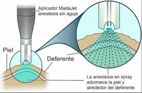 Moratto realiza exclusivamente vasectomía sin bisturí, mediante anestesia sin aguja (madajet), con la técnica oclusiva más eficaz conocida (termocauterización más interposición de fascia). La Vasectomia Sin Bisturi Y Sin Aguja Rodriguez Rubio