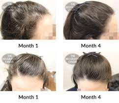 It was 11 inches when it was last june. Hair Growth Success Story Great Service Friendly And Supportive Staff
