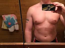 Learn more about gynecomastia and how it's treated. Do I Have Gyno Or Fat To Lose Anabolicminds Com