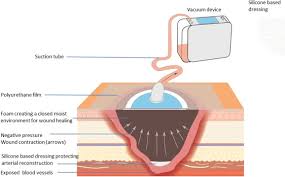 Check spelling or type a new query. Outcome And Complications Using Negative Pressure Wound Therapy In The Groin For Perivascular Surgical Site Infections After Vascular Surgery Annals Of Vascular Surgery
