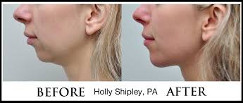 Permanent chin implants can be inserted under the skin and muscles to achieve a. Liquid Chin Lift With Fillers Weston Fort Lauderdale Miami South Florida
