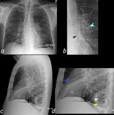 Image result for Lung Abscess