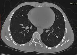 Image result for Broncholithiasis