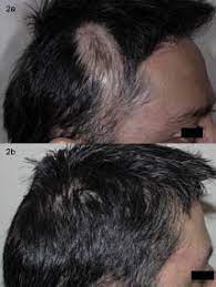 The study is based on hydroxychloroquine sulfate (the active ingredients of plaquenil). Successful Hair Re Growth With Multimodal Treatment Of Early Cicatricial Alopecia In Discoid Lupus Erythematosus Html Acta Dermato Venereologica