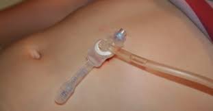 Mit einem besuch hospiz anordnung kann der patient mit würde in seinem eigenen hause zu sterben. Peg Magensonde Kunstliche Ernahrung In Der Intensivpflege