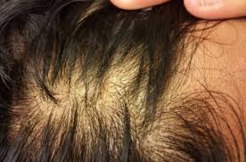 I have never had any scaling or rash on my scalp, so i don't understand the diagnosis. Itchy Scalp And Hair Loss Remedies And Dandruff Strong Hair