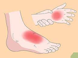 How To Treat Extensor Tendonitis 11 Steps Wikihow