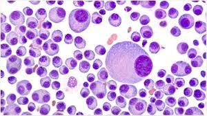 Multiple myeloma is a cancer of plasma cells. Multiple Myeloma Imaging Strategies
