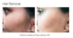If one type of electrolysis doesn't kill your remember that electrolysis hair removal is essentially an invasive process designed to obliterate hair follicles. Comfort Blend Electrolysis Opening Hours 1135 Lansdowne St W Peterborough On