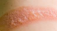Most burns heal without becoming infected. First Degree Burn Causes Symptoms Treatments