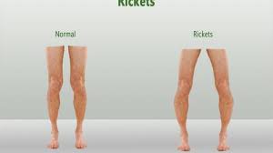 Image result for Rickets