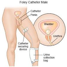 Image result for Urethral Catheterization