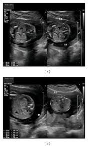 A Coronal Images Of The Fetal Kidneys At 19 Weeks And 4 Days Of Download Scientific Diagram