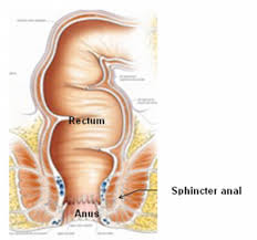 Colorectal cancer (colon cancer) is the cause of many cancer deaths. Defecographie Spina Bifida