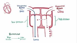Image result for Ventricular Septal Defect