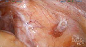 Ovarian Remnant Syndrome In Ovarian Tissue Ectopically Implanted In Trocar Site A Case Report Journal Of Minimally Invasive Gynecology