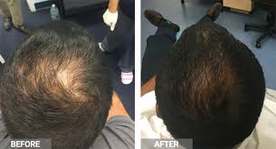 Limited data is present for prp's direct stimulation of hair growth. Are Prp Sessions Helpful For Regrowing Hair Will There Be Any Side Effects Quora