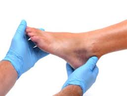Do you have a jones fracture of the 5th metatarsal? Jones Fracture Symptoms Treatments Surgery Recovery