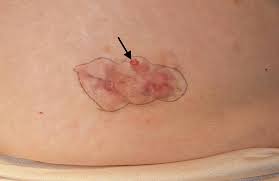 Image result for Dermatofibrosarcoma Protuberans