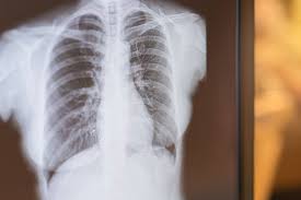 Low dose ct scan (low dose computed tomography scan) No Survival Difference With Once Daily Vs Twice Daily Radiotherapy In Small Cell Lung Cancer Cancer Therapy Advisor